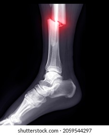 X-ray Image Of Ankle Joint Showing Fracture Tibia And Fibula Bone.'