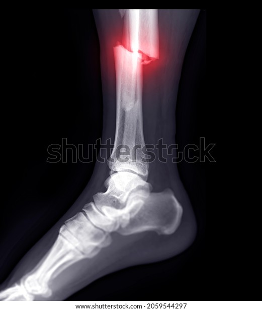 Xray Image Ankle Joint Showing Fracture Stock Illustration 2059544297 ...