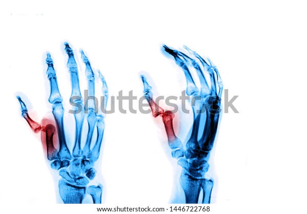 手の指のx線画像は 親指の骨折 脱落した指を示します 医療のコンセプト のイラスト素材