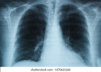 Chest X Ray Complicated Pneumonia Stock Photo (Edit Now) 1510430681