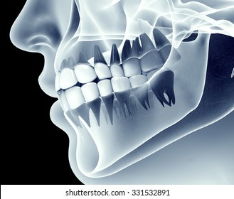 x-ray image of a jaw with teeth.