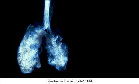 Xray Lungs Of Smoker