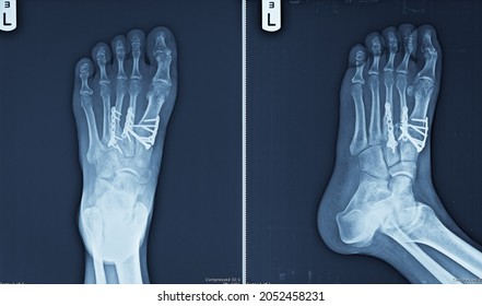 1,208 Internal Fixation Images, Stock Photos & Vectors | Shutterstock