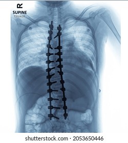 X-ray Of A Scoliosis Patient Showing After Corrective Deformity Surgery. The Disease Is Adolescent Idiopathic Scoliosis (AIS).operating Procedure.blue Tone.