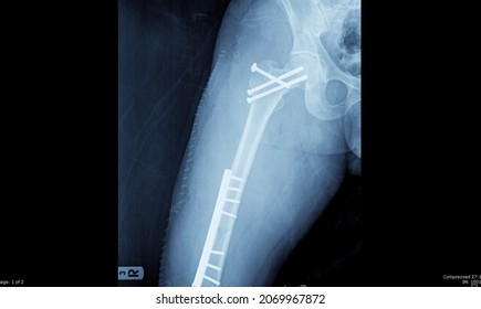 Rayos X que muestran el cuello de fractura cerrada del fémur derecho con Fémur de Fractura.bajo reducción abierta y placa de fijación interna y tornillo de fémur de cuello con placa ORIF y tornillo de fémur.