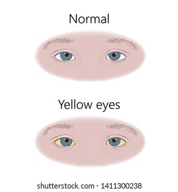 Jaundice Eyes Images, Stock Photos & Vectors | Shutterstock