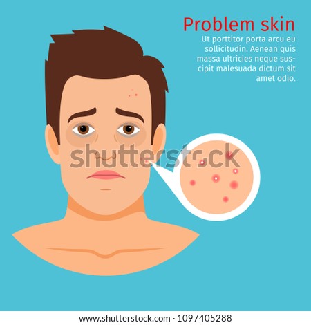 Young man face problem skin with acne, illustration