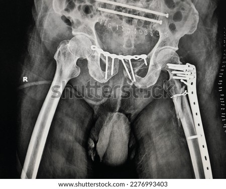 film​ X-ray​ post​ operation​ Open​ reduction​ internal​fixation​ Pelvic​