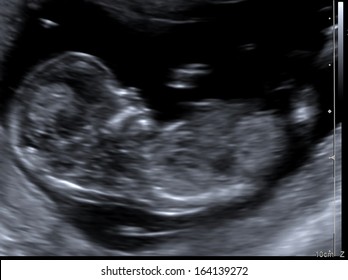 12 week old fetus, gender is not yet known/Fetus ultrasound