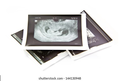 12 weeks infant baby ultrasound Image