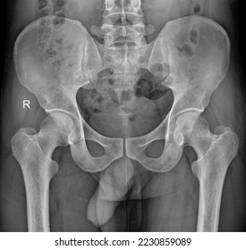 16 years old boy normal pelvis x-Ray view with both hip joint   - Shutterstock ID 2230859089