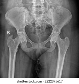 18 Years Old Female Pelvis Anteroposterior Radiograph 