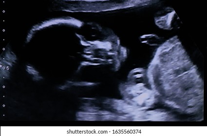 20 weeks baby fetus face looking directly at the screen during a half pregnancy ultrasound