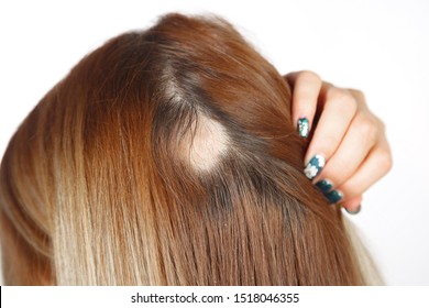 30 Year Old Caucasian Woman With Spot Alopecia, Bald Spot On Her Head