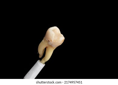 39-year-old Female Smoker Tooth. Extracted Tooth On A Black Background   