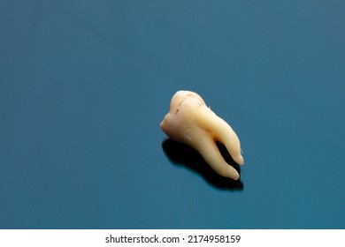 39-year-old Female Smoker Tooth. Extracted Tooth On A Blue Background   