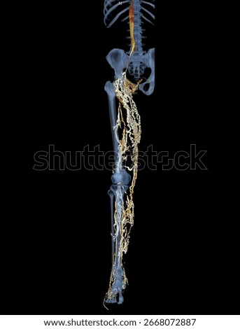 3D CT venogram image showing abnormal varicosities in the right lower limb.
 Useful for vascular imaging, radiology education, venous insufficiency study, and medical research.