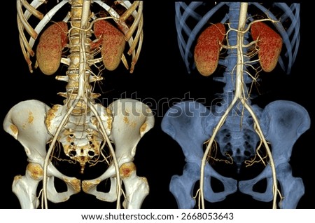 3D CTA image of abdominal all artery including aorta, renal, iliac, mesenteric, celiac, and kidney arteries.
 Useful for radiology, surgical planning, vascular research, and medical education.