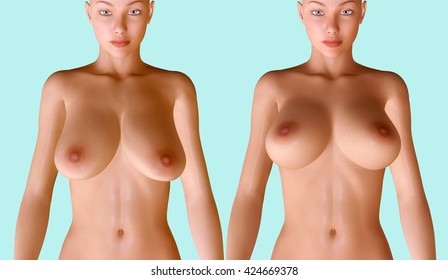 3d illustration of breast procedures before and after