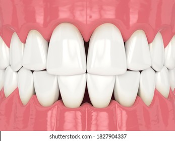 3d render of human jaw with black triangles between teeth