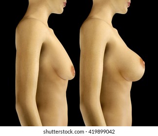 3d rendered illustration Breast Enlargement with Uplift surgery before and after