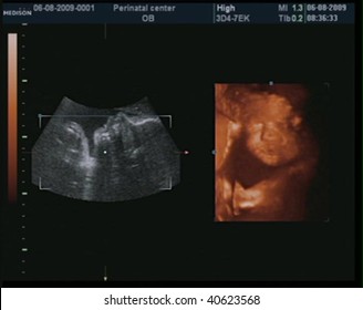 A 3D Ultrasound Of A 27 Week Old Baby.