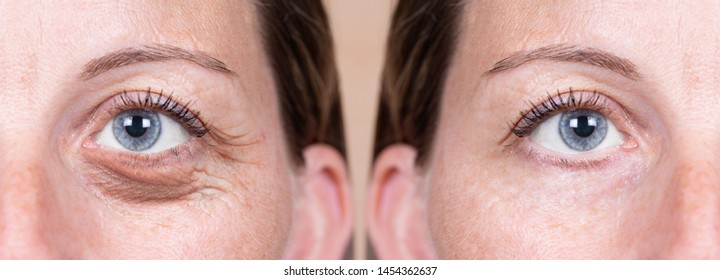 A 40 year old Caucasian woman shows the before and after results of blepharoplasty. Plastic surgery to remove dark puffy eyebags from the delicate area below the eyes.