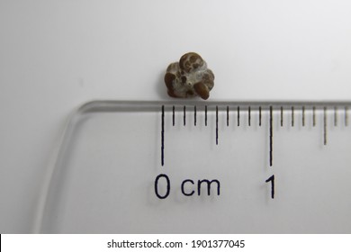 5mm Kidney Stone passed after lithotripsy procedure