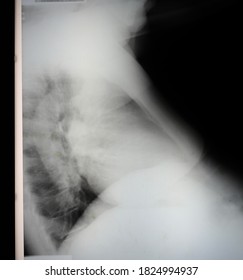 A 69 year old man with progressive shortness of breath due to massive bilateral pulmonary emboli of both main pulmonary arteries and marked dilated superior vena cava. History of phlebitis.