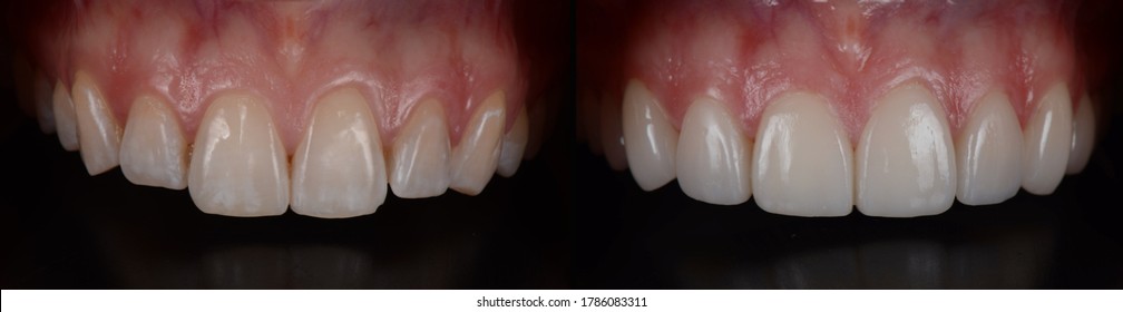 8 pressed ceramic veneers to align the from teeth, before and after.