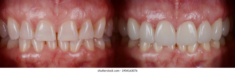 8 pressed ceramic veneers treatment on 8 upper teeth.