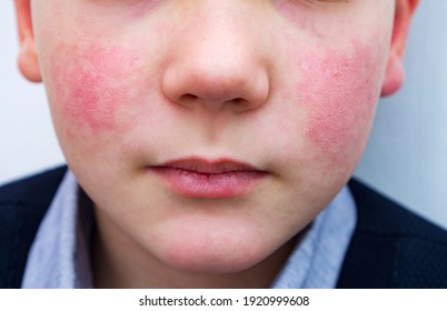 8 years old child with red cheeks- enterovirus infection, diathesis or allergy symptoms. Redness and peeling of the skin on the face. 