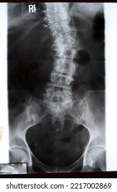 An 80 Year Old Woman With Levoscoliosis Centered At L2 And Mild Degenerative And Narrow Bilateral Hip Joint Disease. 