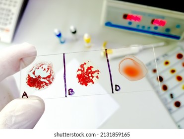 AB Negative Rare Blood Group Testing By Slide Agglutination