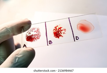 AB Negative Rare Blood Group Testing By Slide Agglutination