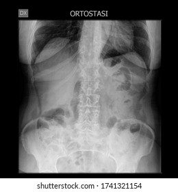 Abdomen Xray Orthostasis Disease X-ray