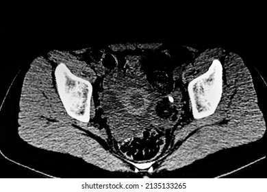 Abdominal CT Scan Of The Abdomen Showing A Teratoma Tumor In The Left Ovary. Medical Themes