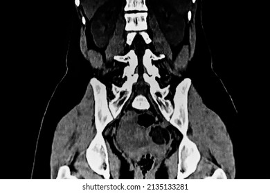 Abdominal CT Scan Of The Abdomen Showing A Teratoma Tumor In The Left Ovary. Medical Themes