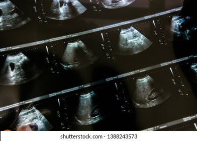 Abdominal CT Scan (note: Patient Details Have Been Suppressed)