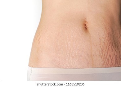 Abdominal Scar Marked Pattern