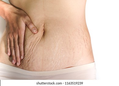 Abdominal Scar Marked Pattern