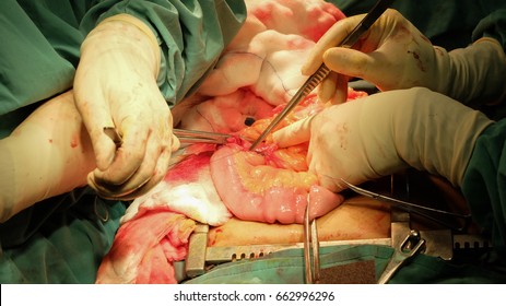 Abdominal Surgery removing Colon Cancer. Step by step surgery.