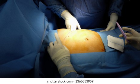 Abdominal Surgery showing Subcostal Incision for Elective Splenectomy.