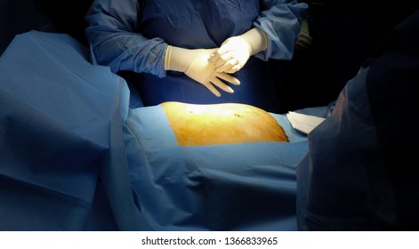 Abdominal Surgery showing Subcostal Incision for Elective Splenectomy.