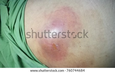 Abdominal Wall Abscess Stock Photo (Edit Now) 760744684 ...