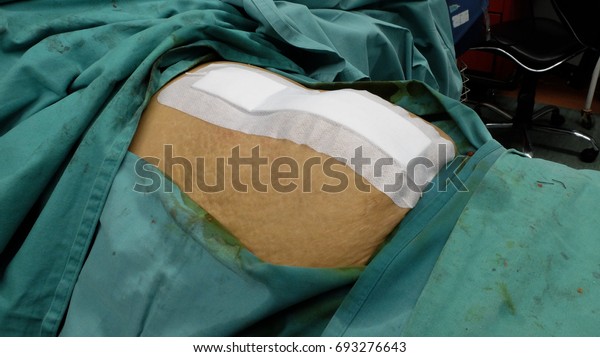 Abdominal Wound Closure Stapler Dressing Step Stock Photo Edit Now