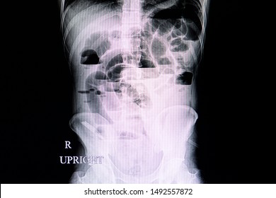 An Abdominal Xray Film Of A Patient With Small Intestinal Obstruction Showing Air Fluid Levels And Dilated Bowel Loops. A Penrose Drain Shadow Is Seen In The Right Lower Abdominal Area.