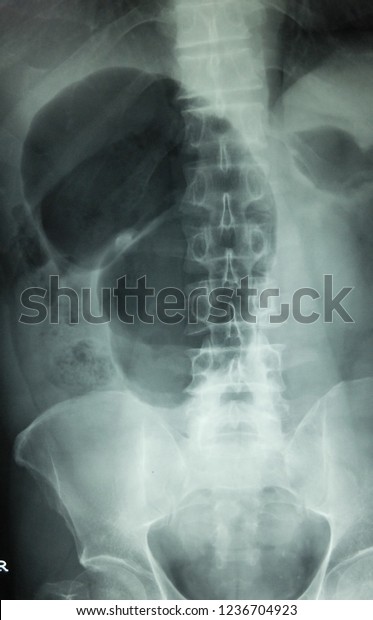 Abdominal Xray Showing Coffee Bean Sign Stock Photo Edit Now