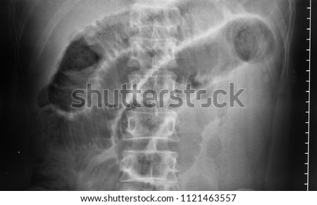 Abdominal Xray showing dilated segment of Small Bowel. Operation findings confirmed Ischaemic Bowel secondary to Internal Herniation.