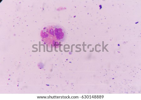 Abnomal cell in pleural fluid